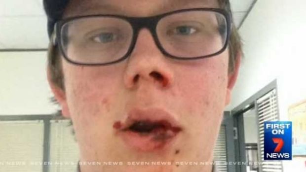 Josh Lawrie after the 'one punch' attack. Photo: Channel 7